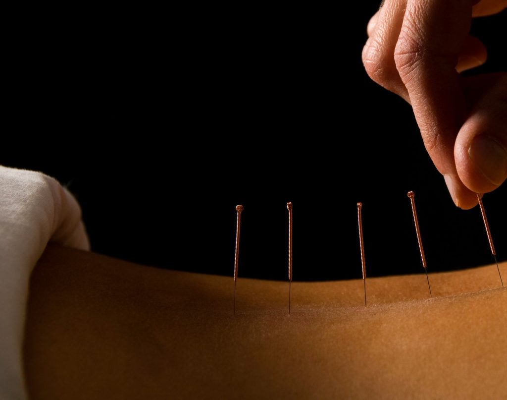 siriroj-acupuncture-explained